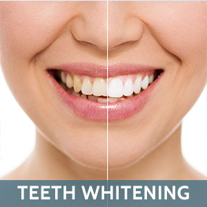 Teeth Whitening